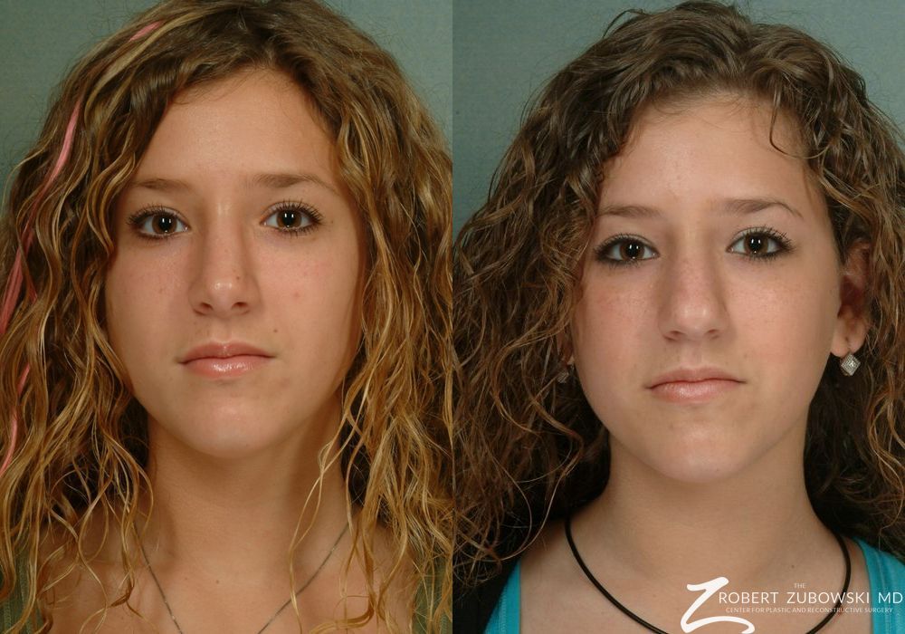 Rhinoplasty - Case 3889