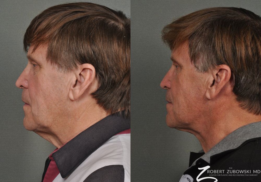 Neck Lift - Thumbnail 3