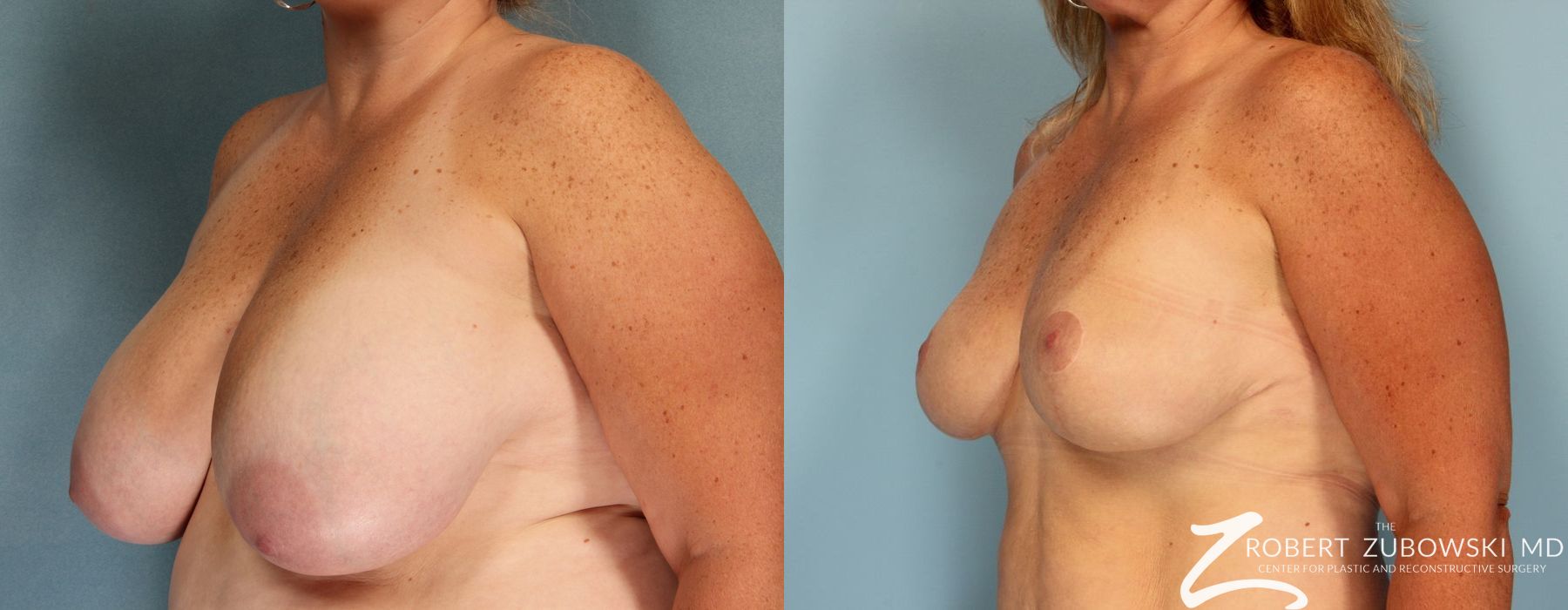 Breast Reduction - Thumbnail 2