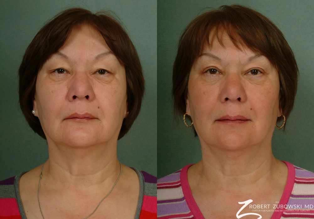 Blepharoplasty - Case 3742