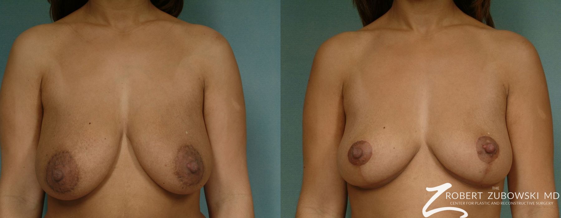 Breast Lift - Case 3660