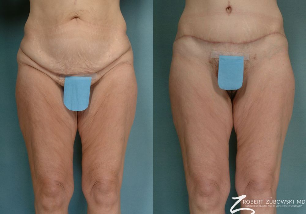 Body Lift - Case 3505