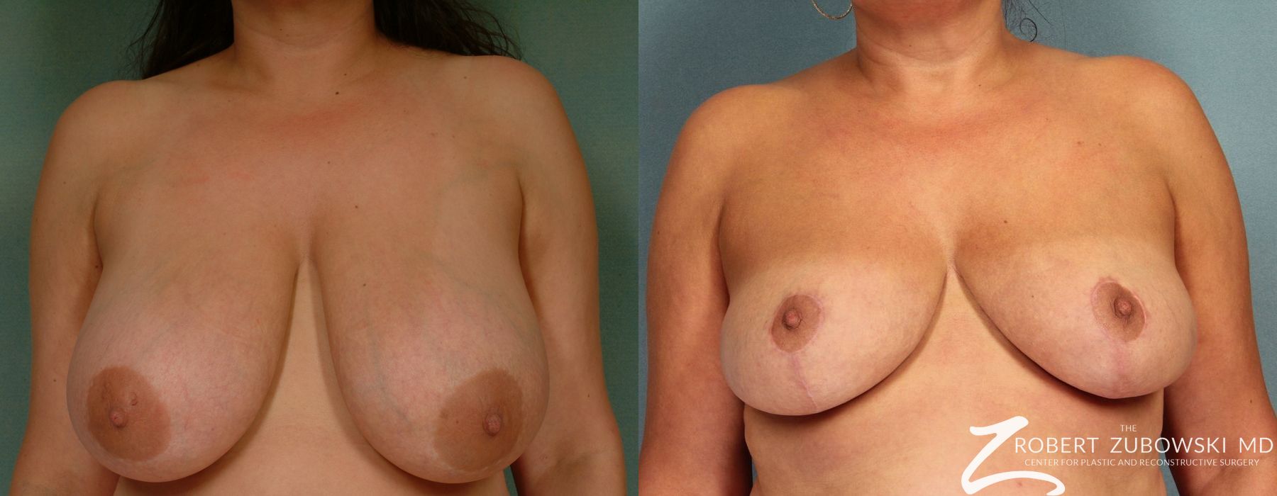 Breast Reduction - Case 3684