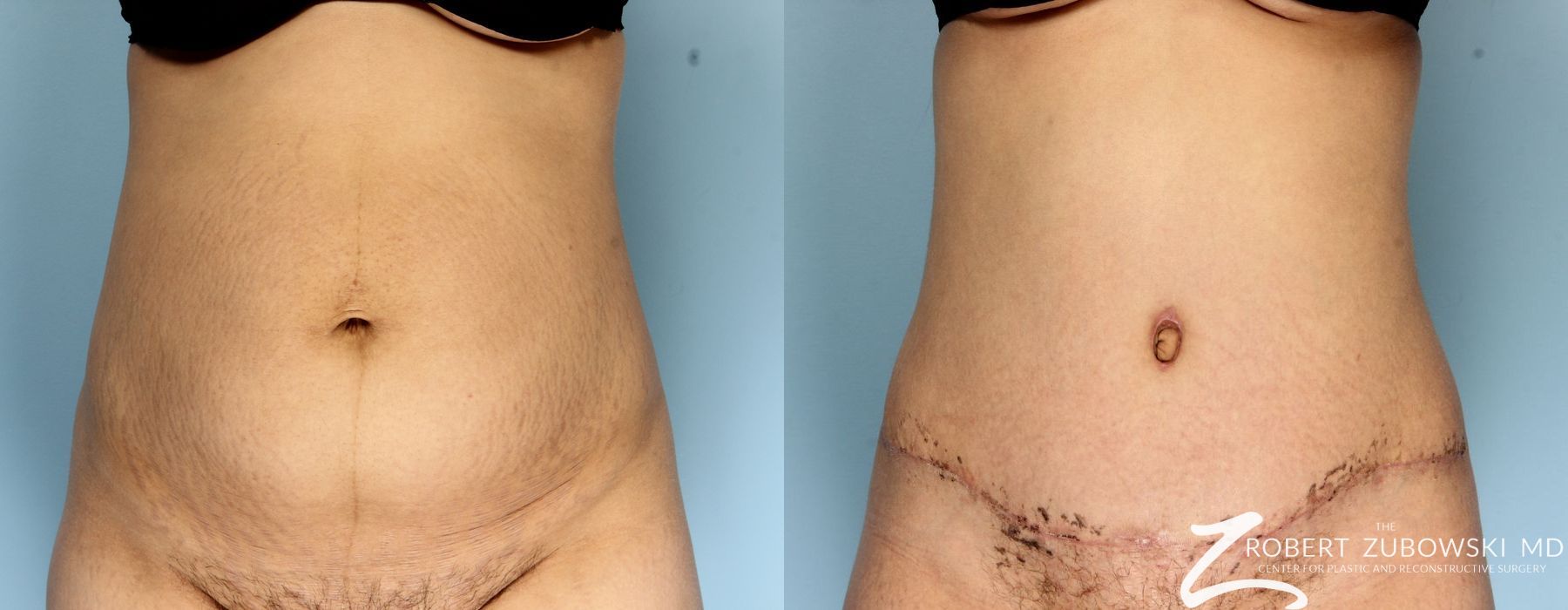 Liposuction - Case 3565