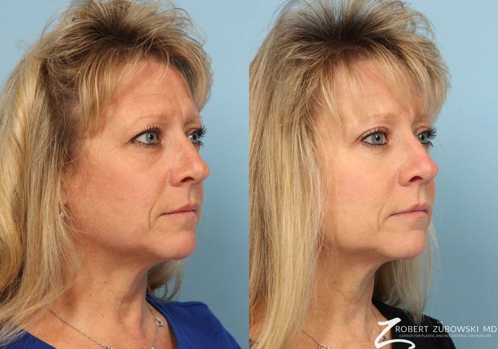 Blepharoplasty - Thumbnail 2