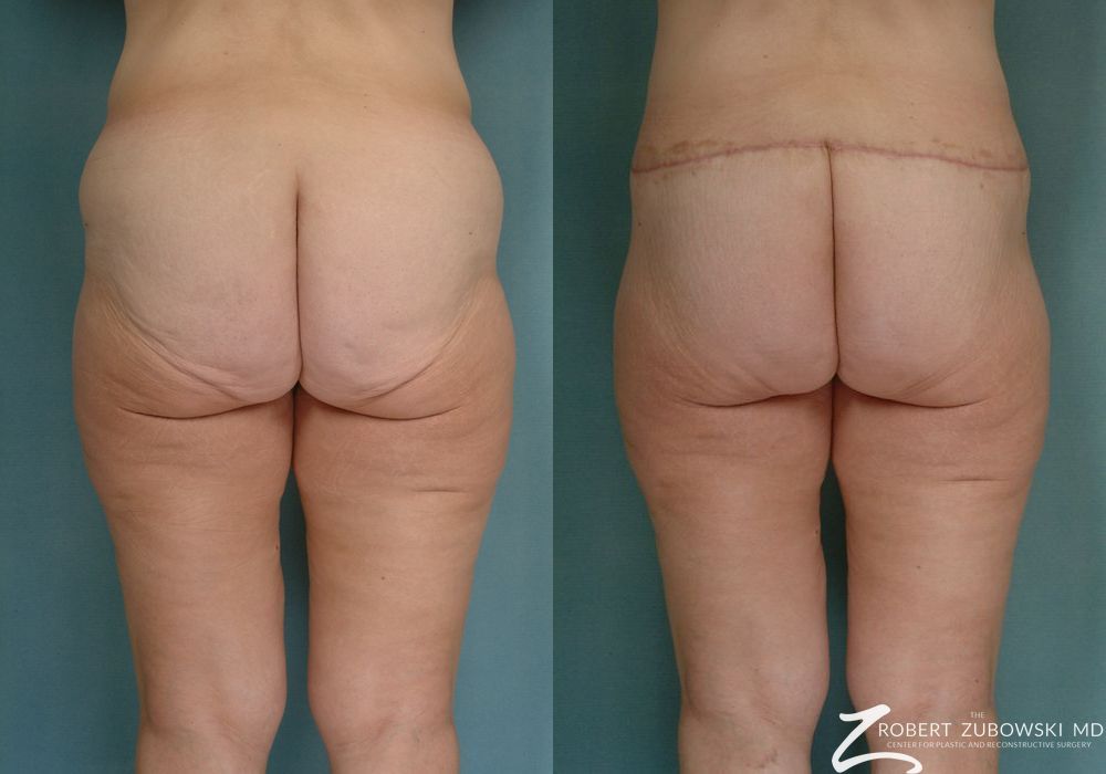 Body Lift - Thumbnail 2