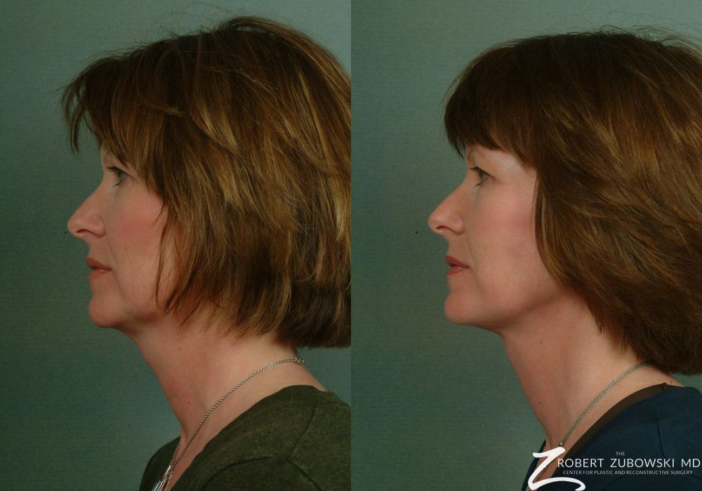 Facelift - Thumbnail 2