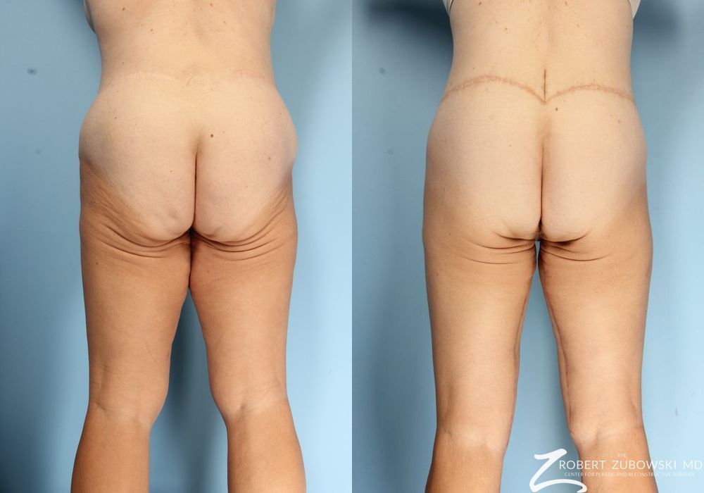 Thigh Lift - Thumbnail 2