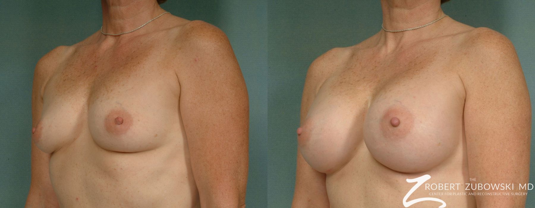 Breast Augmentation - Thumbnail 2