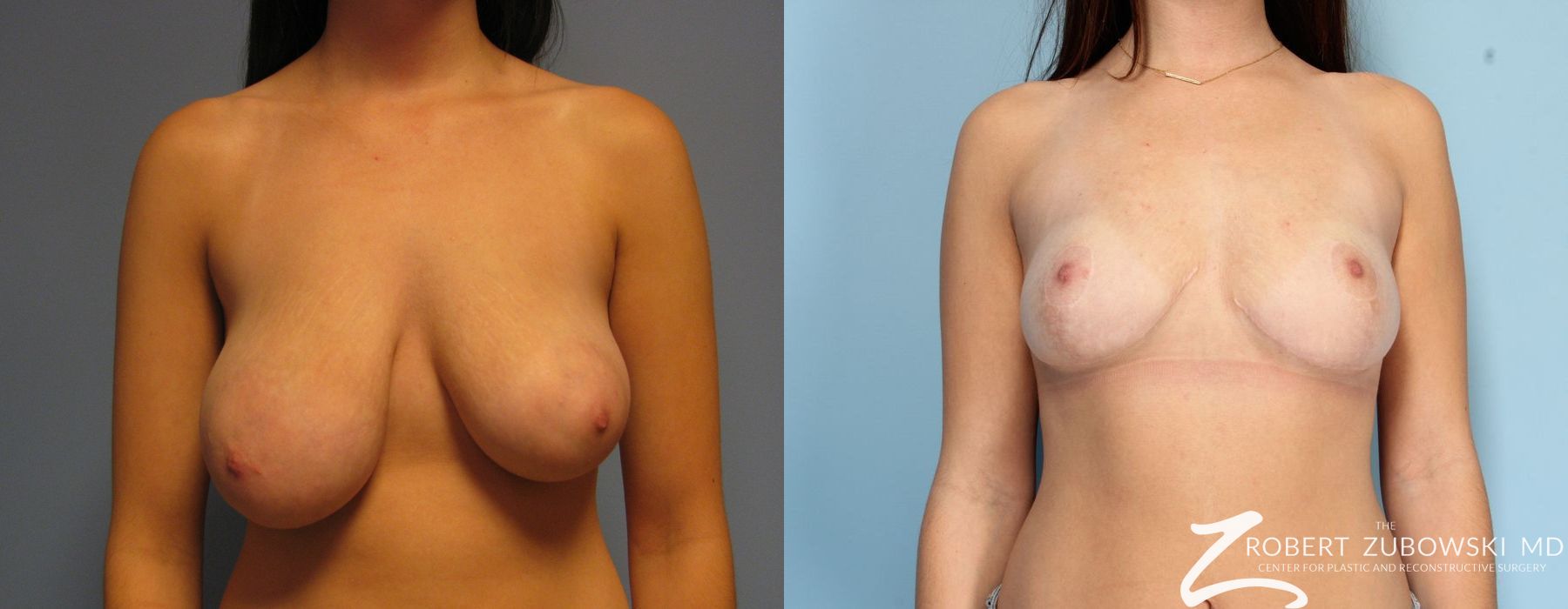 Breast Lift - Case 3654
