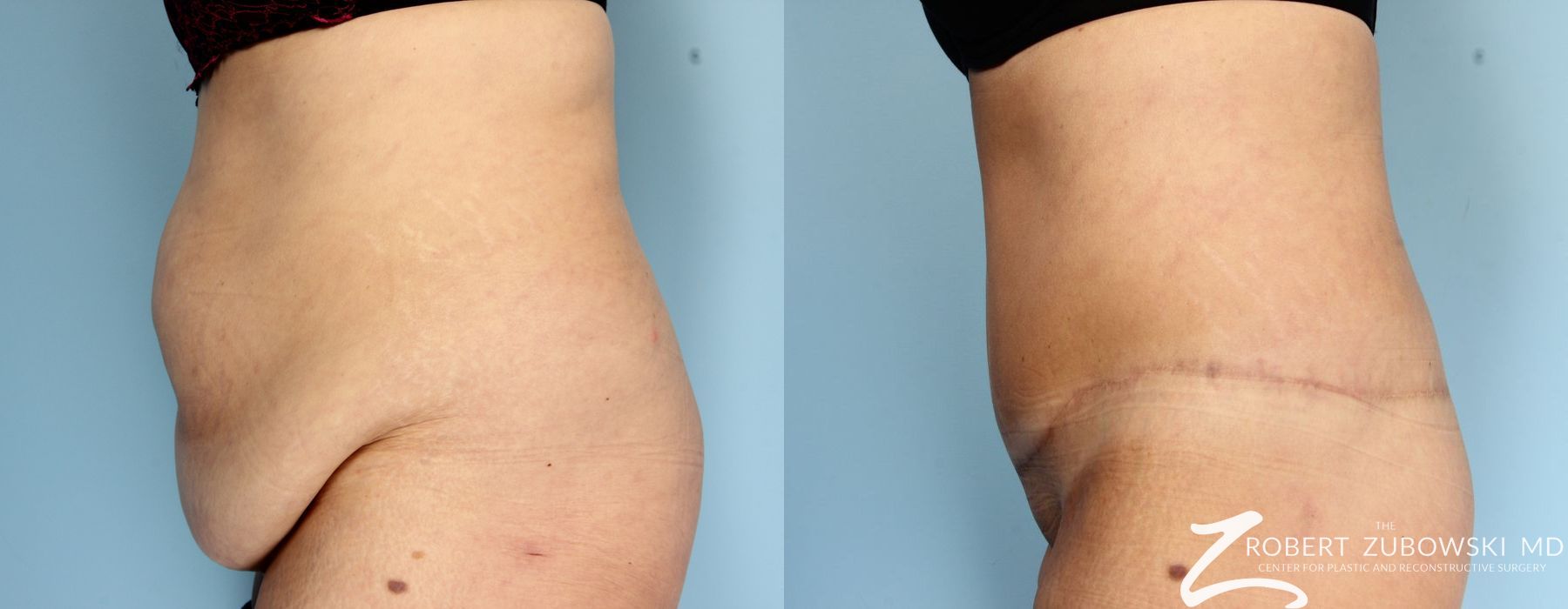 Body Lift - Thumbnail 2