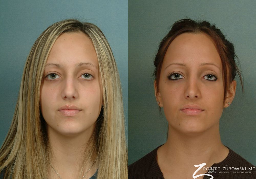 Rhinoplasty - Case 3892