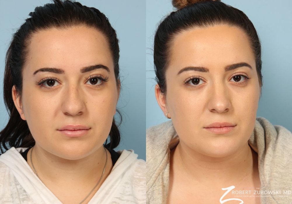 Before and after procedure result