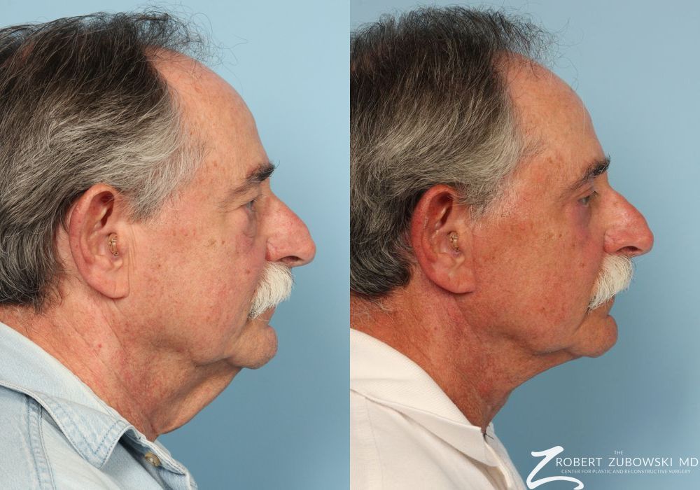 Neck Lift - Thumbnail 2