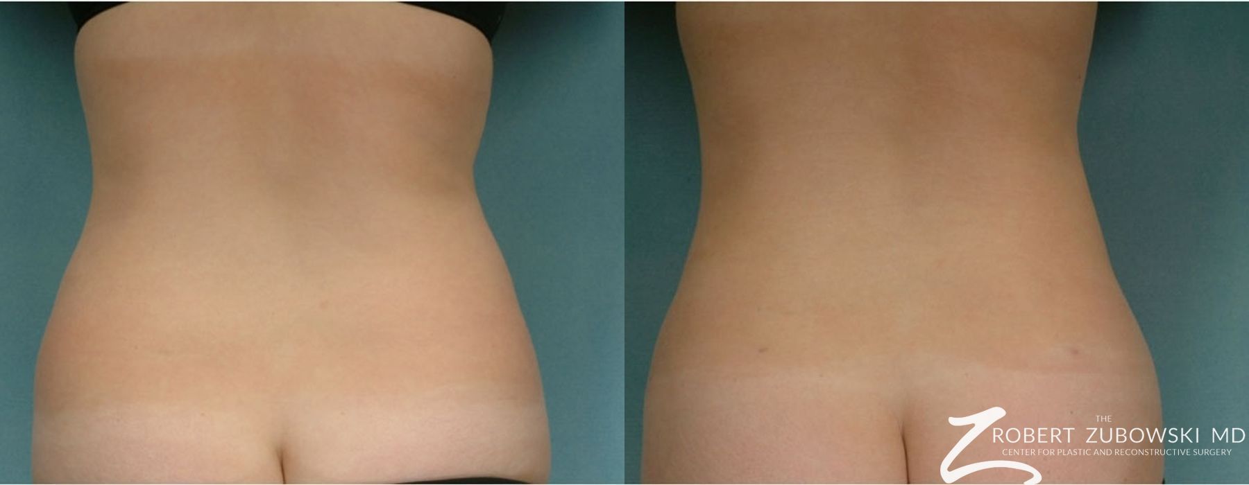 Liposuction - Case 3556