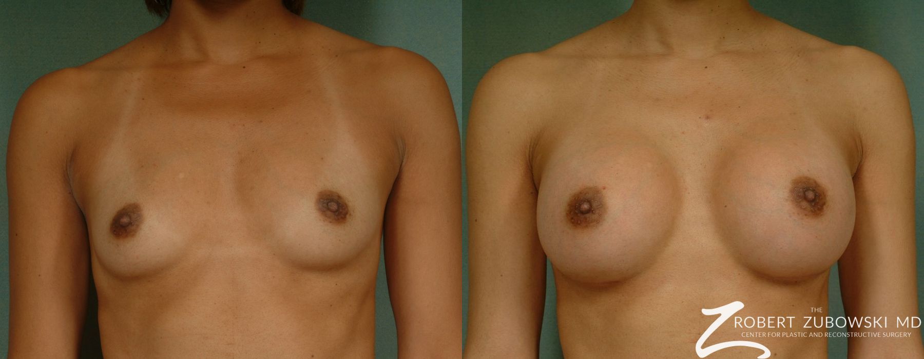 Breast Augmentation - Case 3635