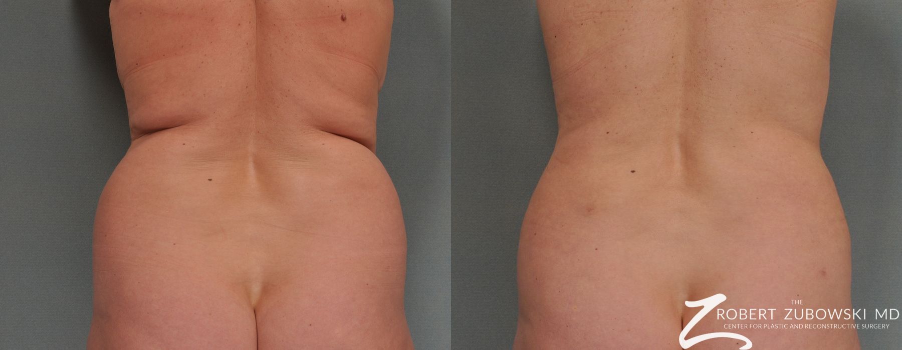 Liposuction - Case 3543