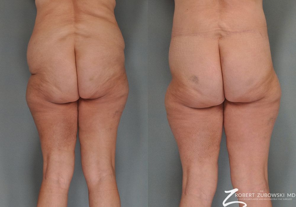 Body Lift - Thumbnail 2