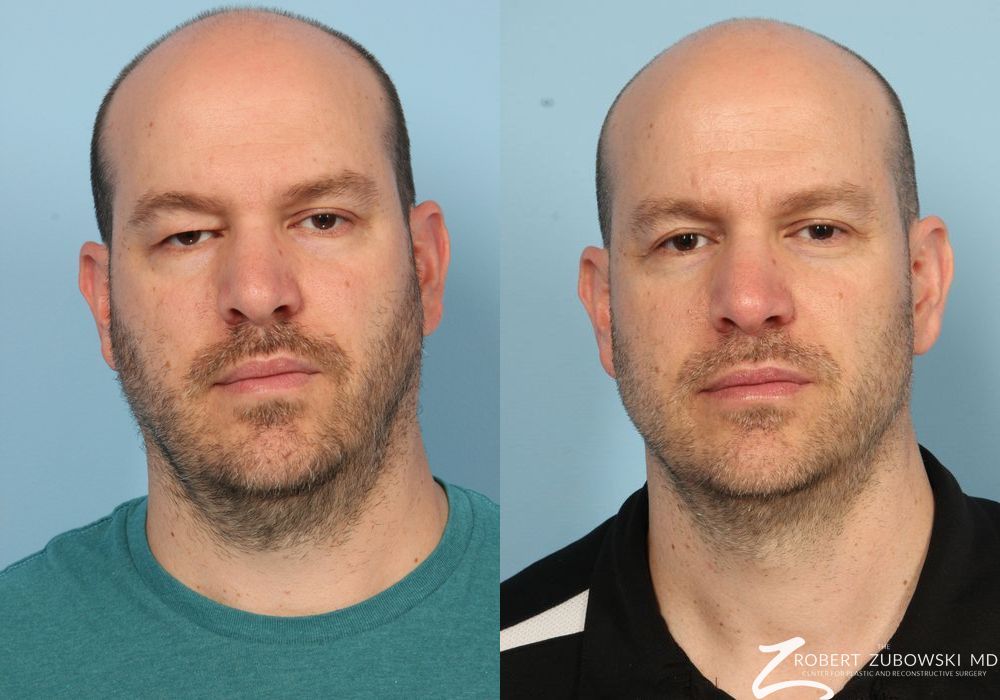 Blepharoplasty - Case 3752