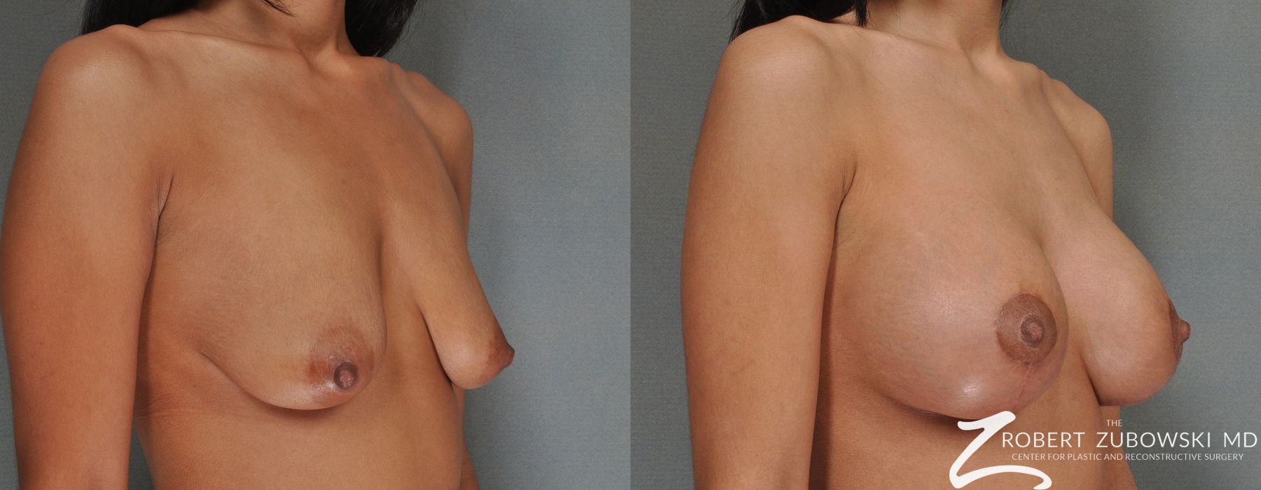 Breast Lift and Augmentation - Thumbnail 2