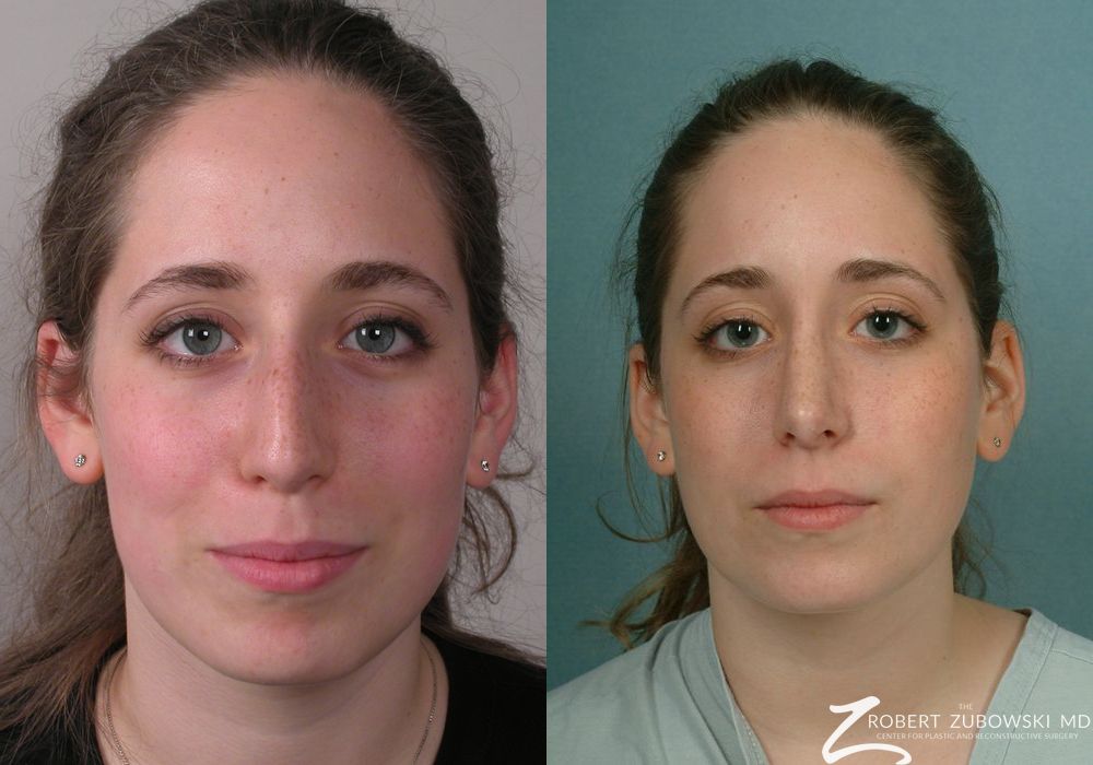 Rhinoplasty - Case 3885