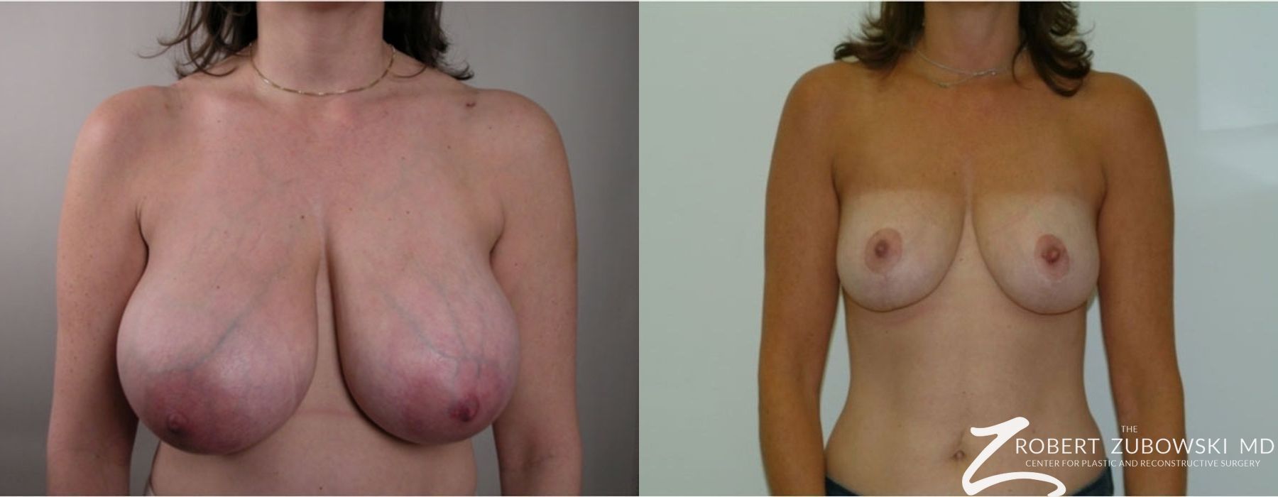 Breast Reduction - Case 3706
