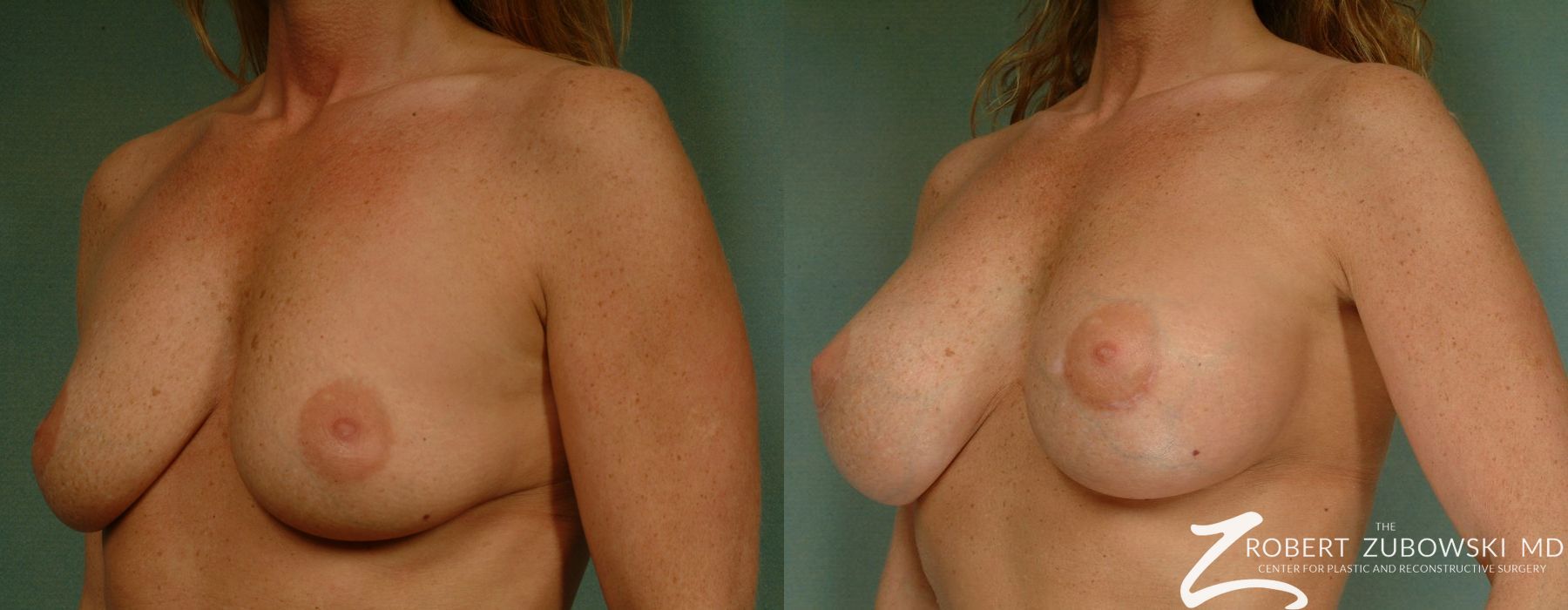 Breast Augmentation - Thumbnail 2