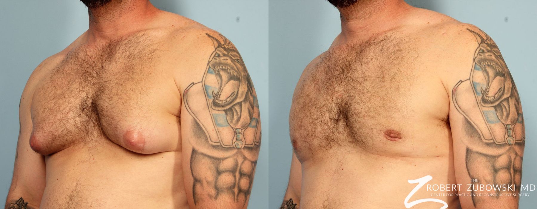 Gynecomastia - Thumbnail 2