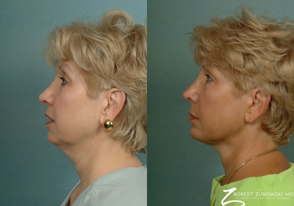 Neck Lift - Thumbnail 2