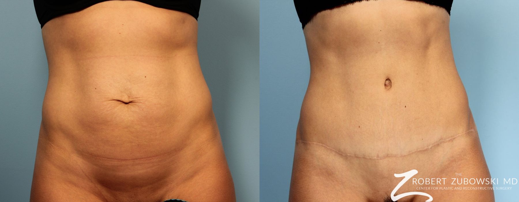 Tummy Tuck - Case 4043