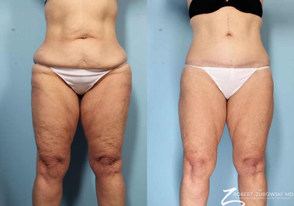 Body Lift - Case 3508