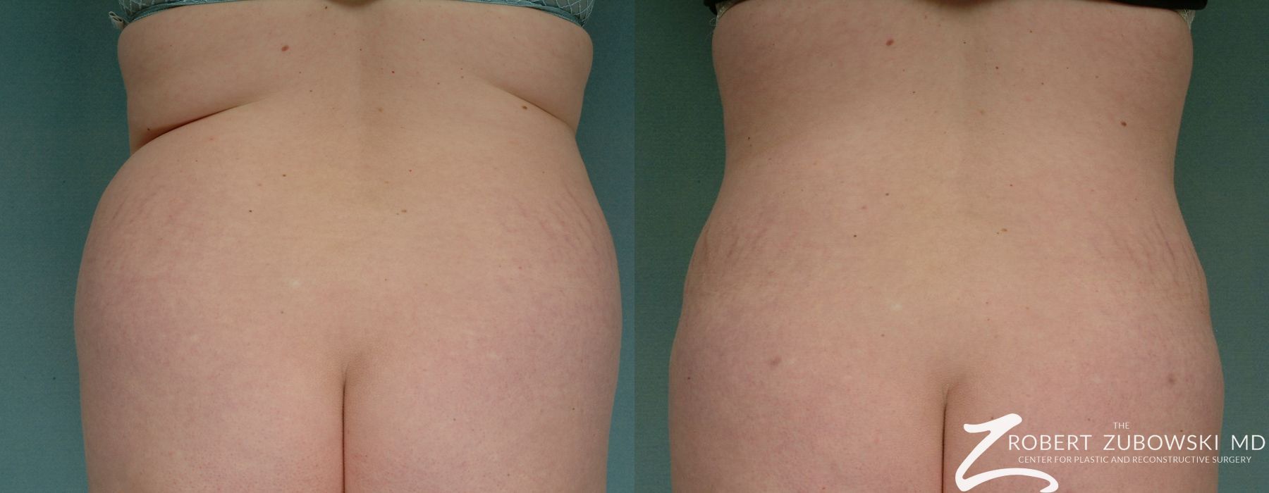 Liposuction - Case 3549