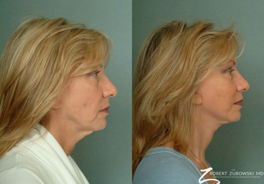 Facelift - Thumbnail 2