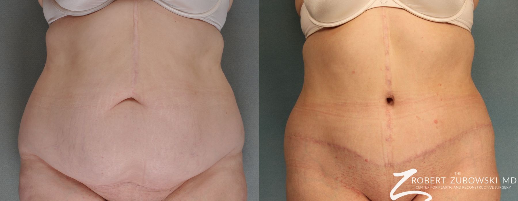 Tummy Tuck - Case 3586