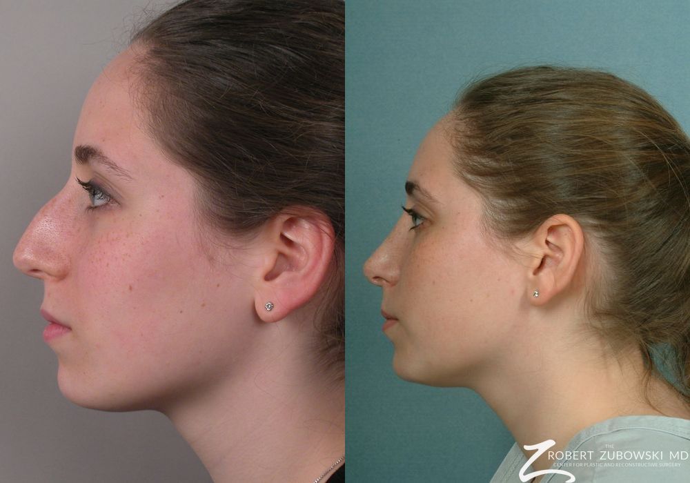 Rhinoplasty - Thumbnail 2