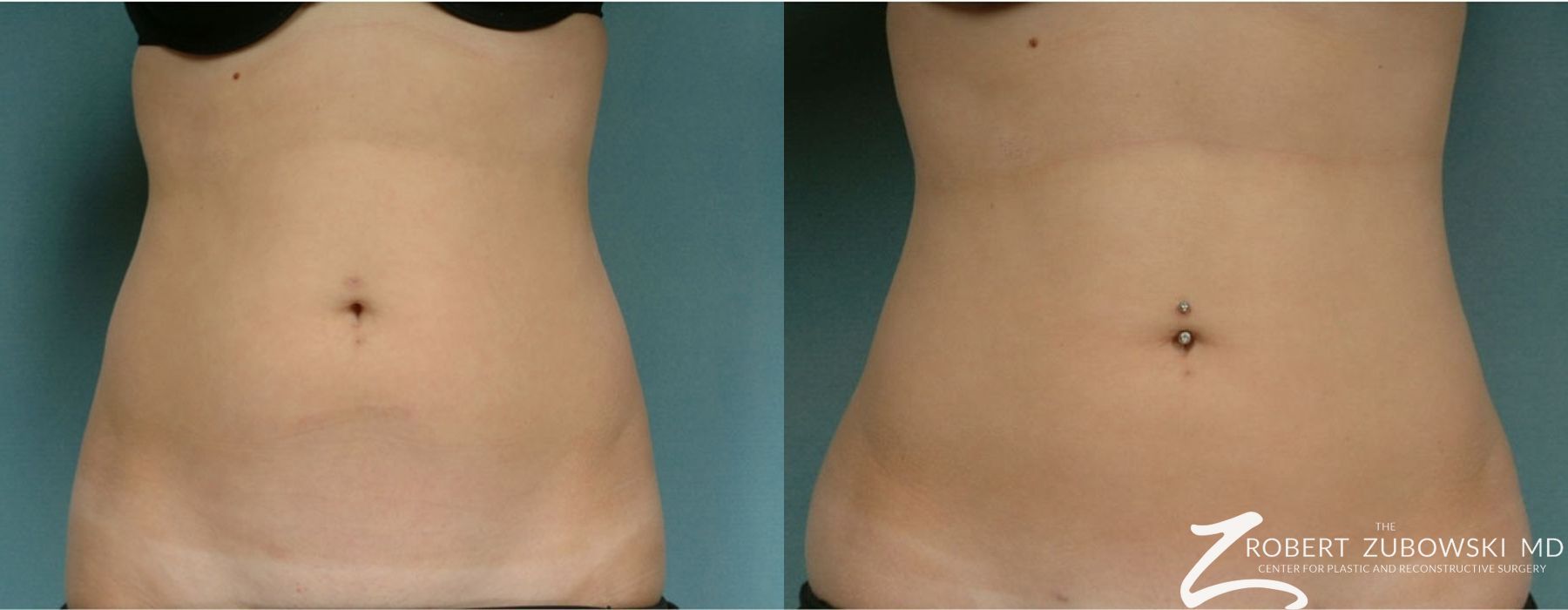 Liposuction - Case 3560