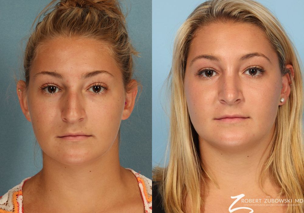 Rhinoplasty - Case 3888