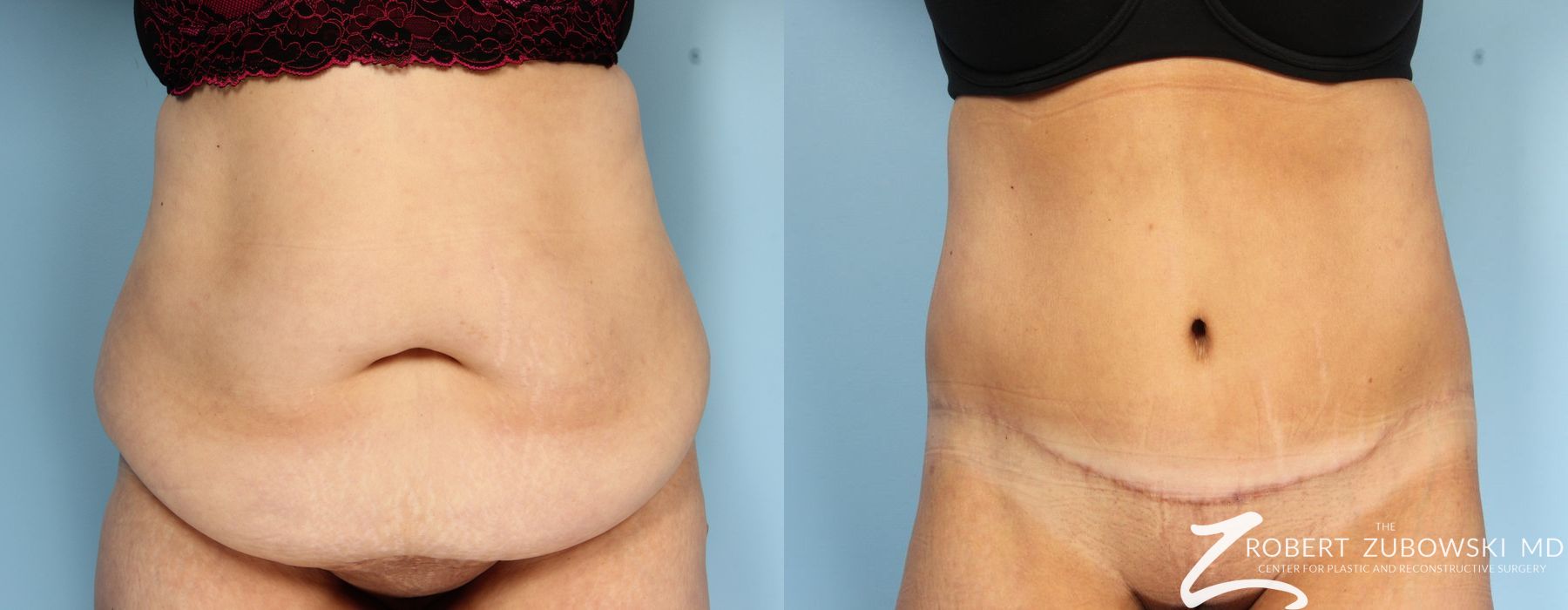 Body Lift - Case 3507