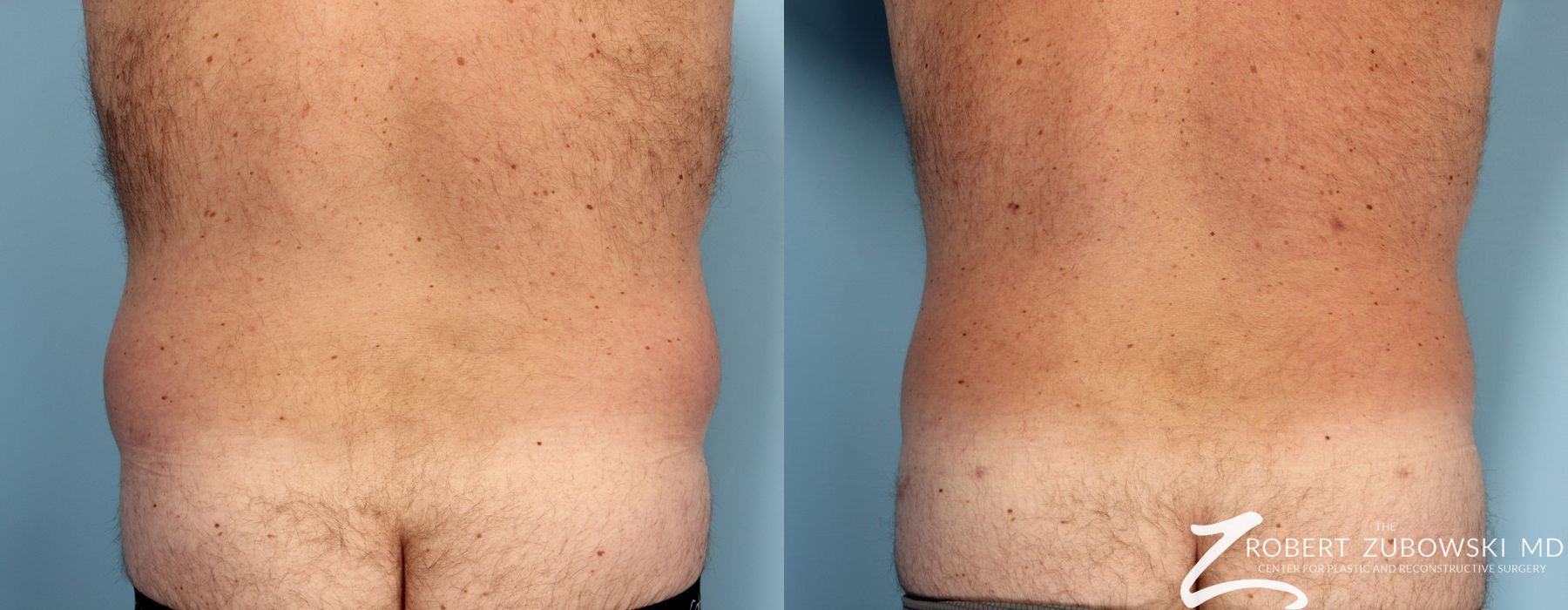 Liposuction - Case 3531