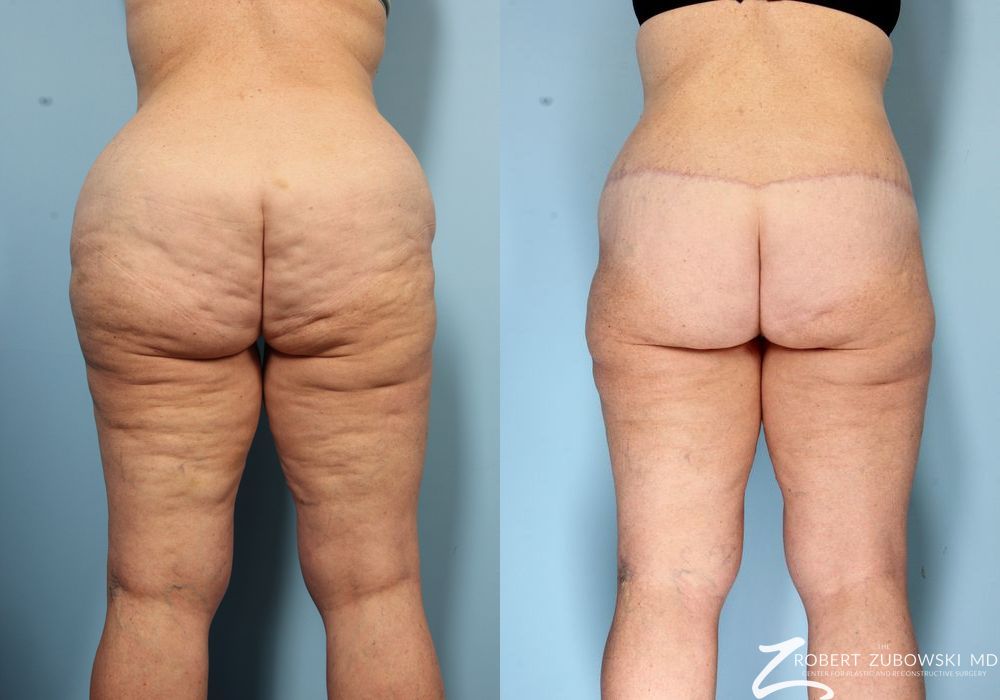 Body Lift - Thumbnail 2