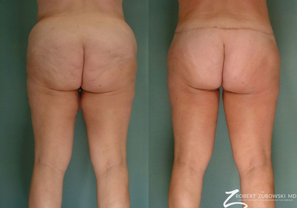 Body Lift - Thumbnail 2