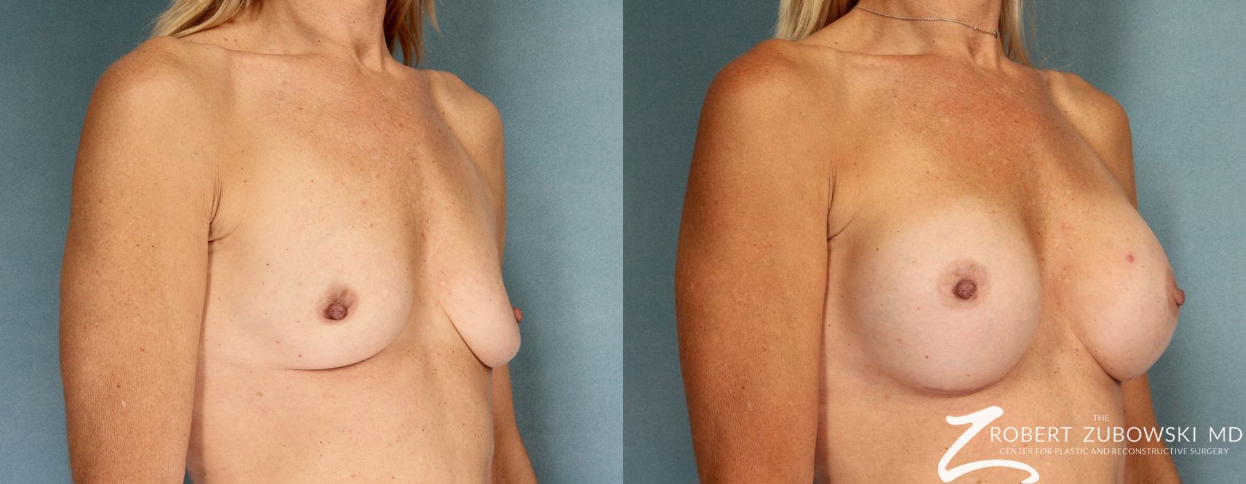 Breast Augmentation - Thumbnail 2