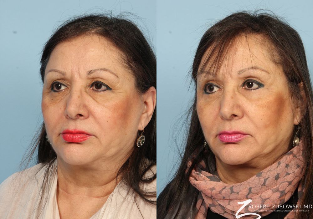 Blepharoplasty - Thumbnail 2