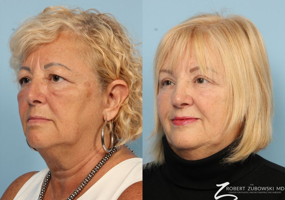 Blepharoplasty - Thumbnail 2