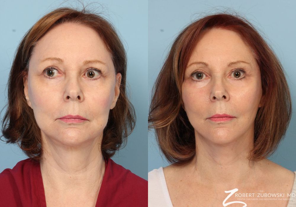 Facelift - Case 3810