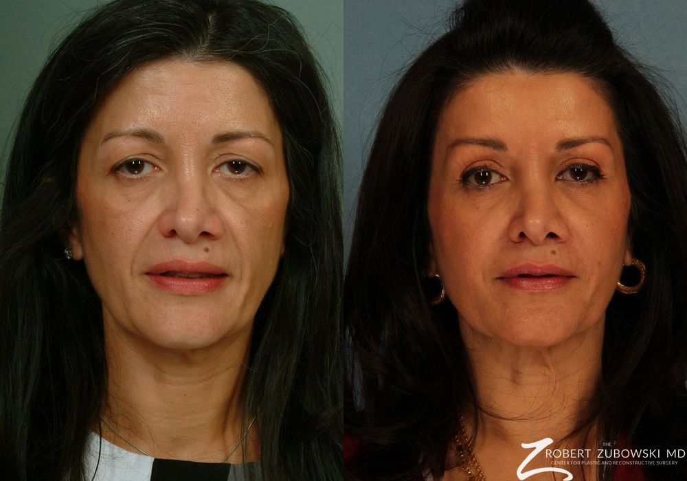 Blepharoplasty - Case 3750
