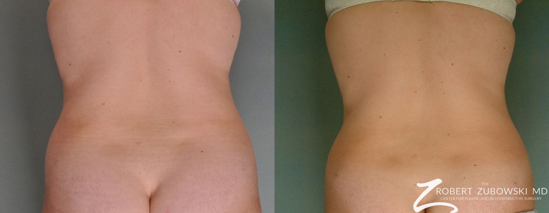 Liposuction - Thumbnail 3