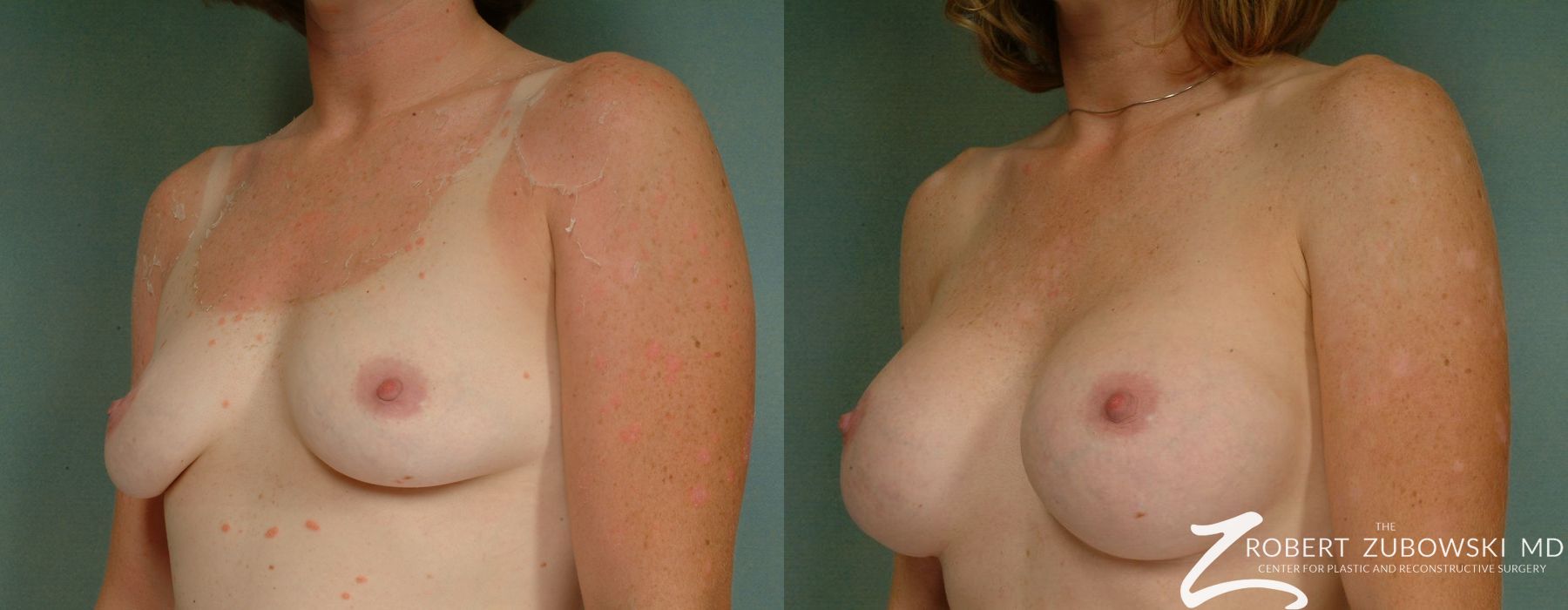 Breast Augmentation - Thumbnail 2