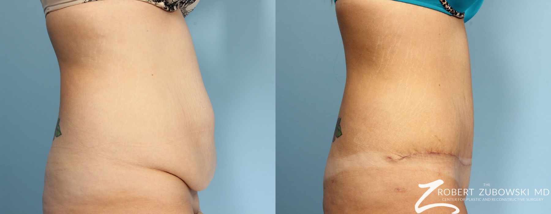 Tummy Tuck - Thumbnail 2