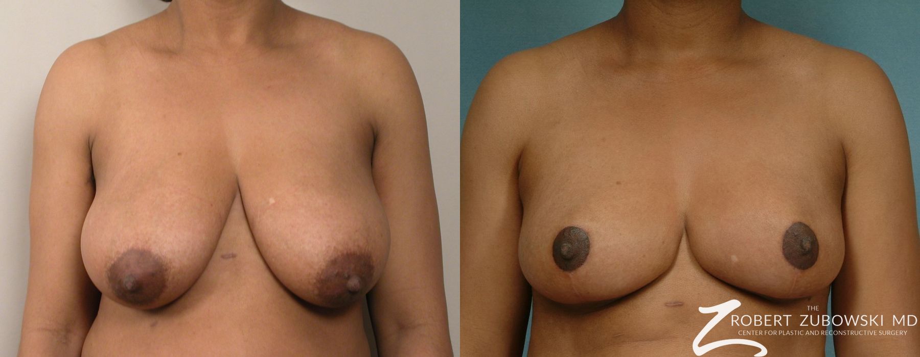 Breast Reduction - Case 3702